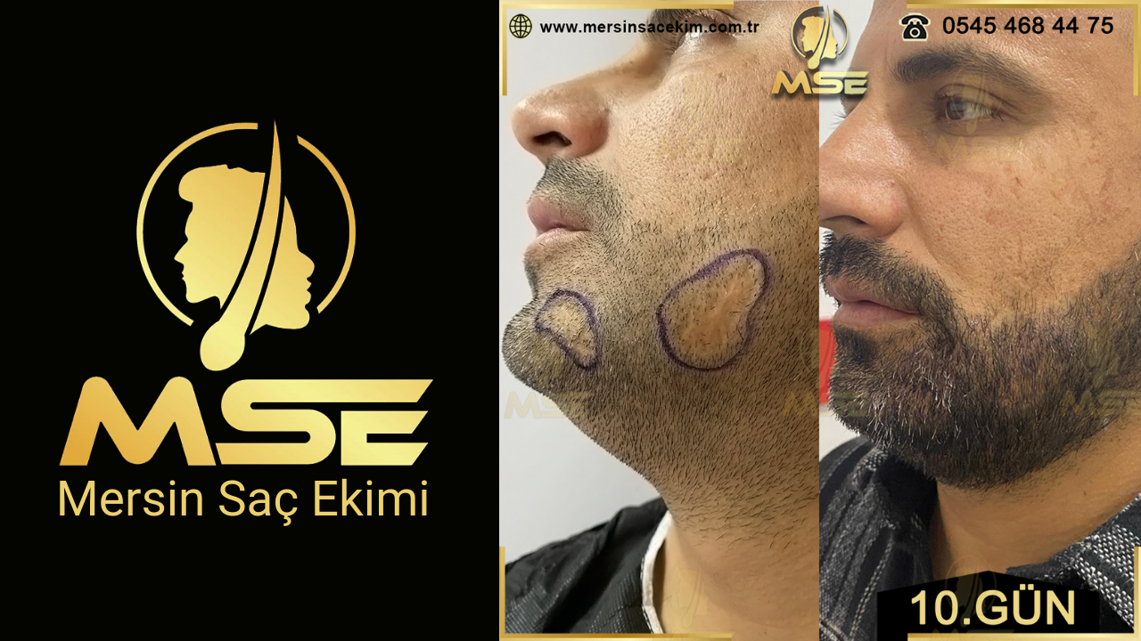 Mersin Saç Ekimi
